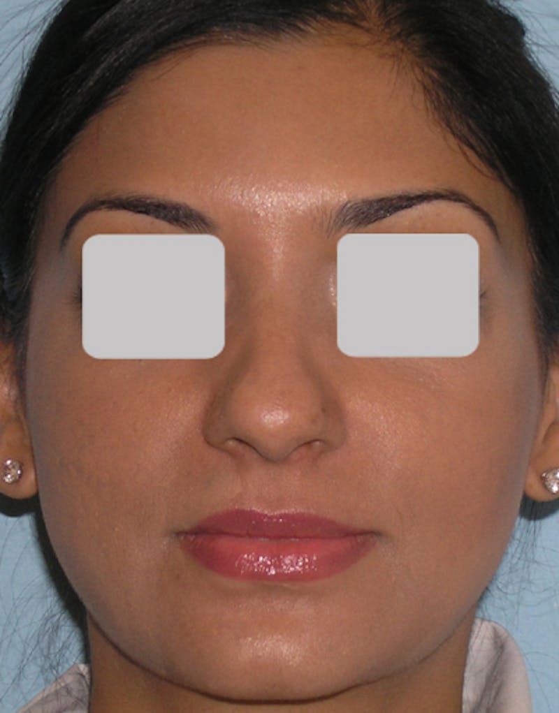 Ethnic Rhinoplasty Before & After Gallery - Patient 305791 - Image 5