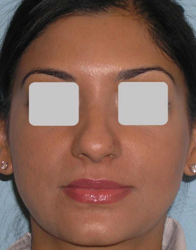 Rhinoplasty  Before & After Gallery - Patient 131503 - Image 5