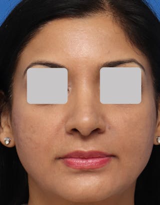 Favorite Ethnic Rhinoplasty Before & After Gallery - Patient 109656 - Image 6