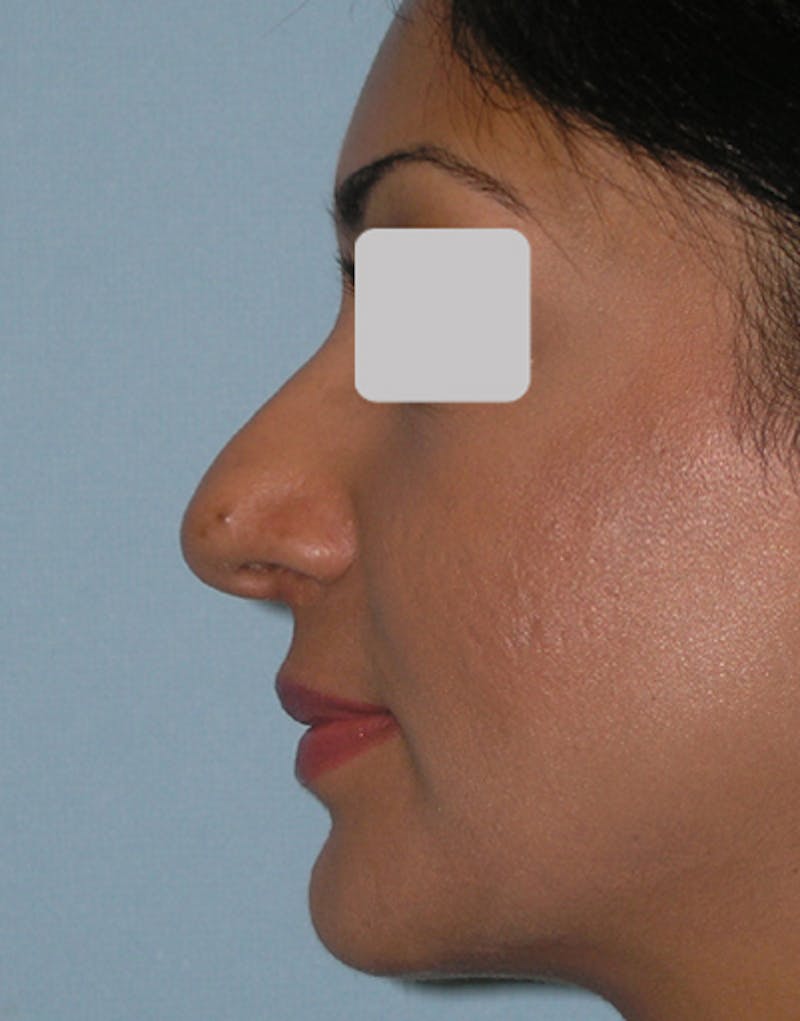 Ethnic Rhinoplasty Before & After Gallery - Patient 305791 - Image 7