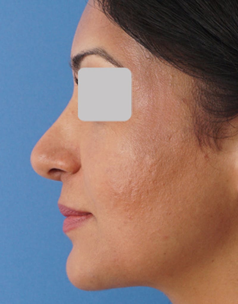 Ethnic Rhinoplasty Before & After Gallery - Patient 305791 - Image 8