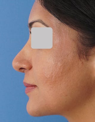 Favorite Ethnic Rhinoplasty Before & After Gallery - Patient 109656 - Image 8