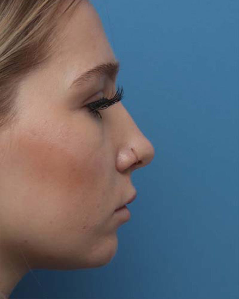 Rhinoplasty Before & After Gallery - Patient 208186 - Image 1
