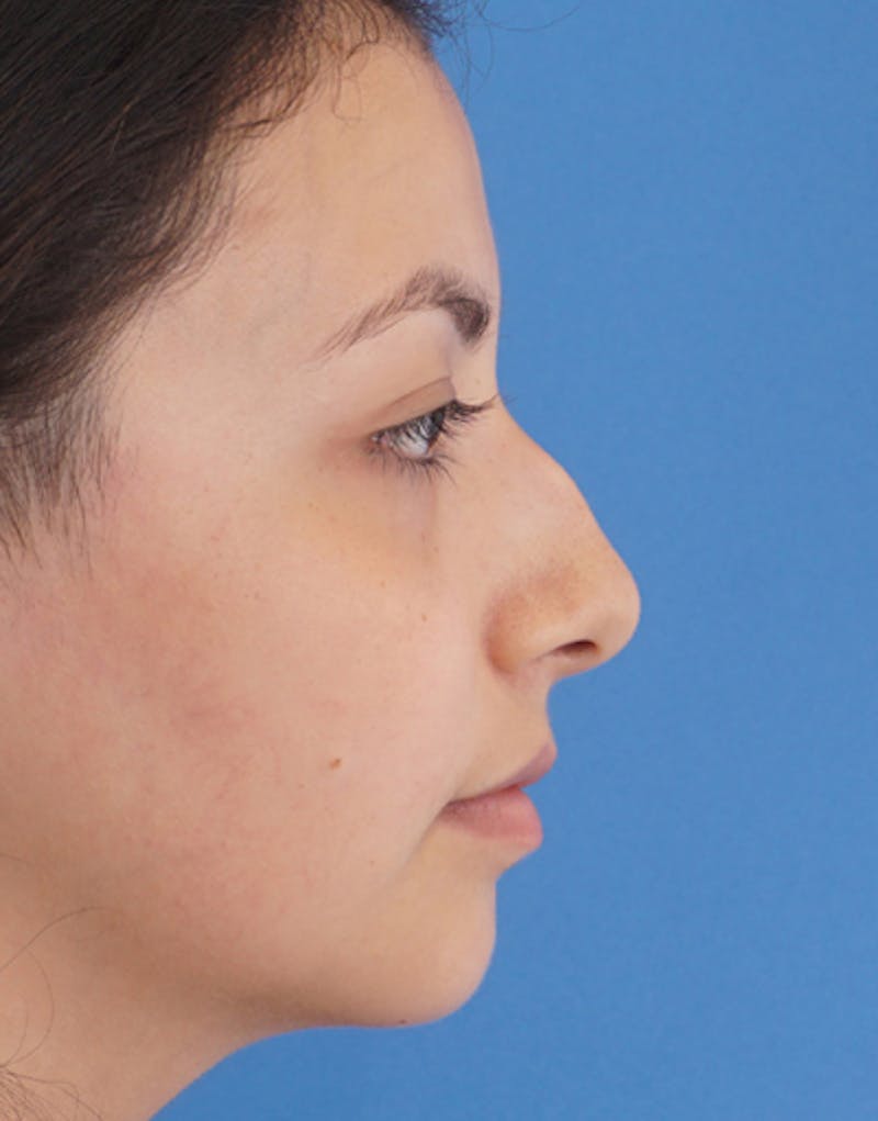 Ethnic Rhinoplasty Before & After Gallery - Patient 233219 - Image 1