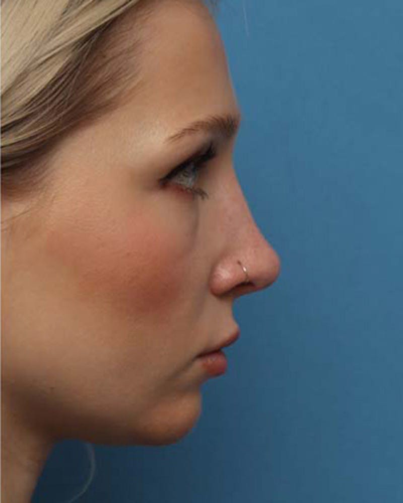 Rhinoplasty Before & After Gallery - Patient 208186 - Image 2