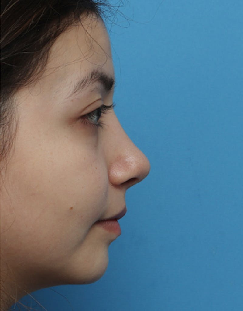 Ethnic Rhinoplasty Before & After Gallery - Patient 233219 - Image 2