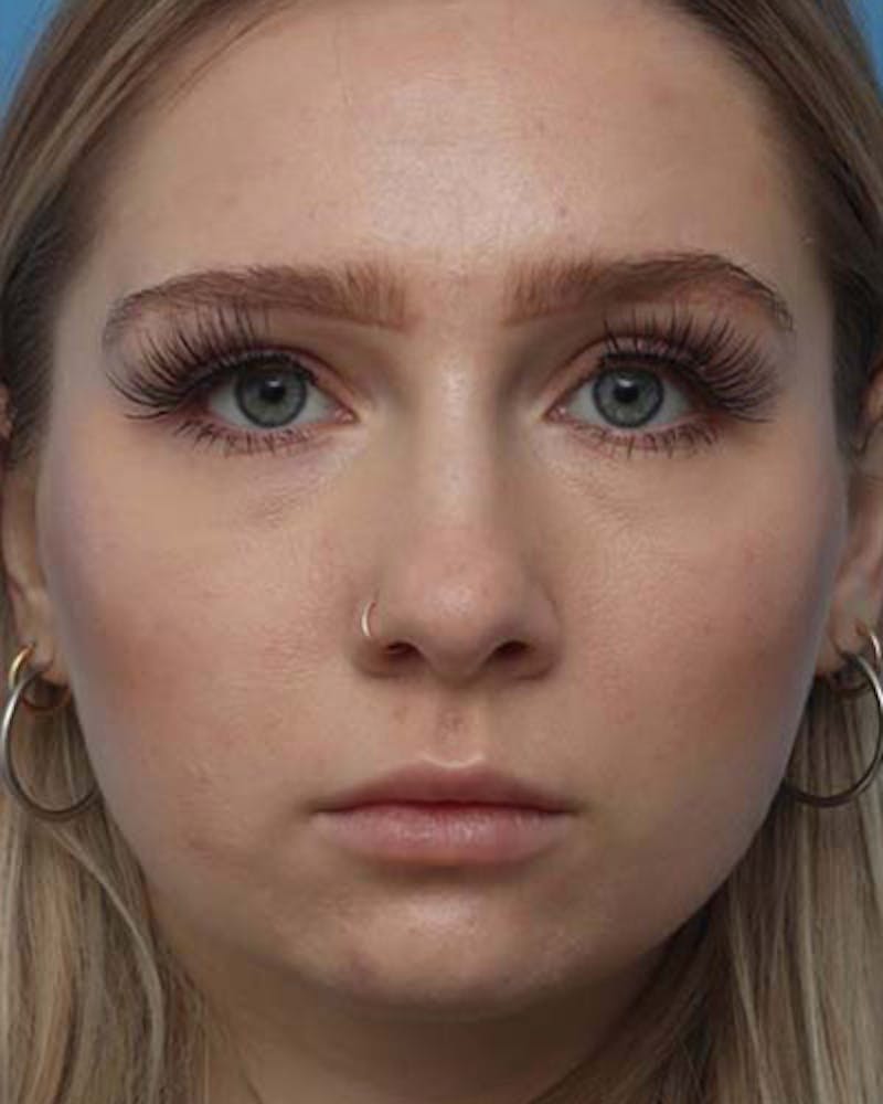 Rhinoplasty Before & After Gallery - Patient 208186 - Image 3