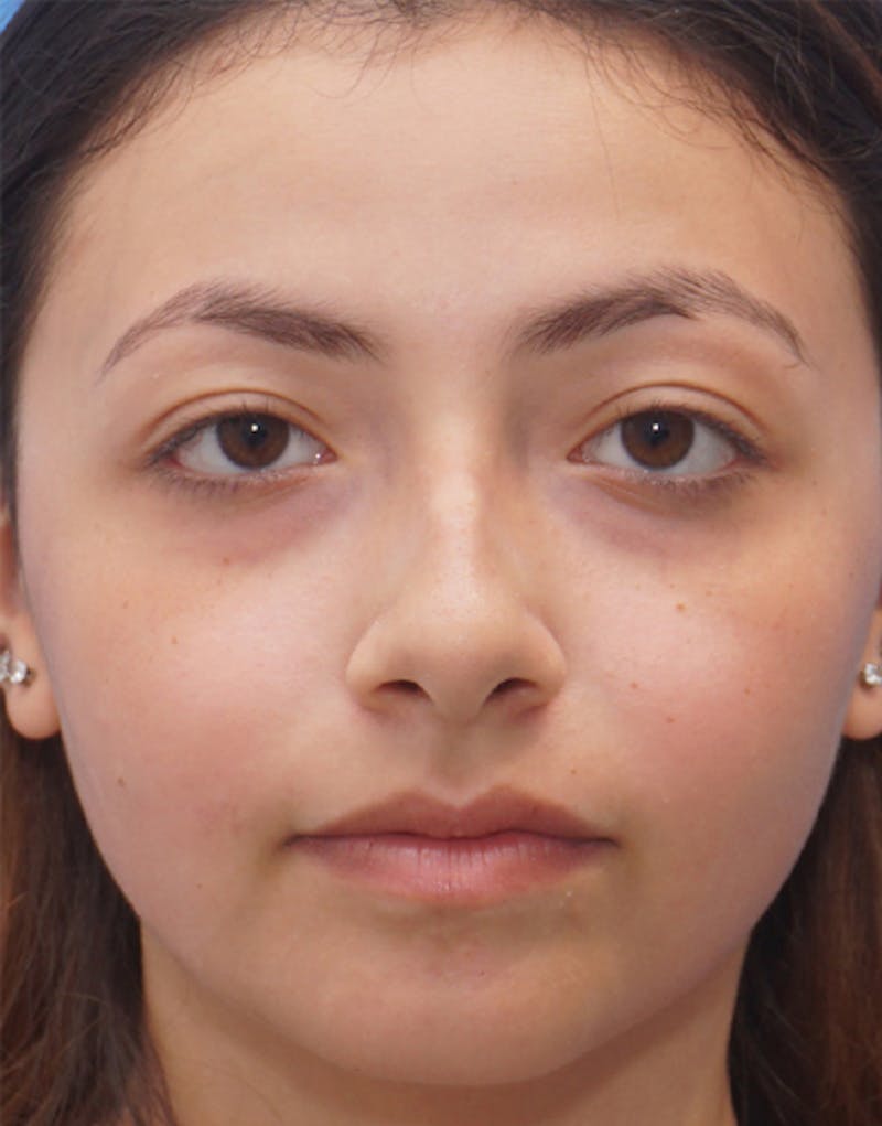 Ethnic Rhinoplasty Before & After Gallery - Patient 233219 - Image 3