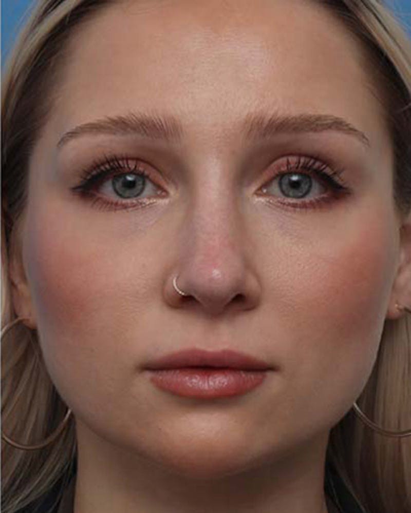Rhinoplasty Before & After Gallery - Patient 208186 - Image 4