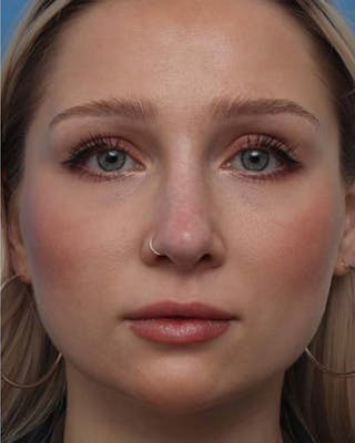 Rhinoplasty Before & After Gallery - Patient 370339 - Image 4