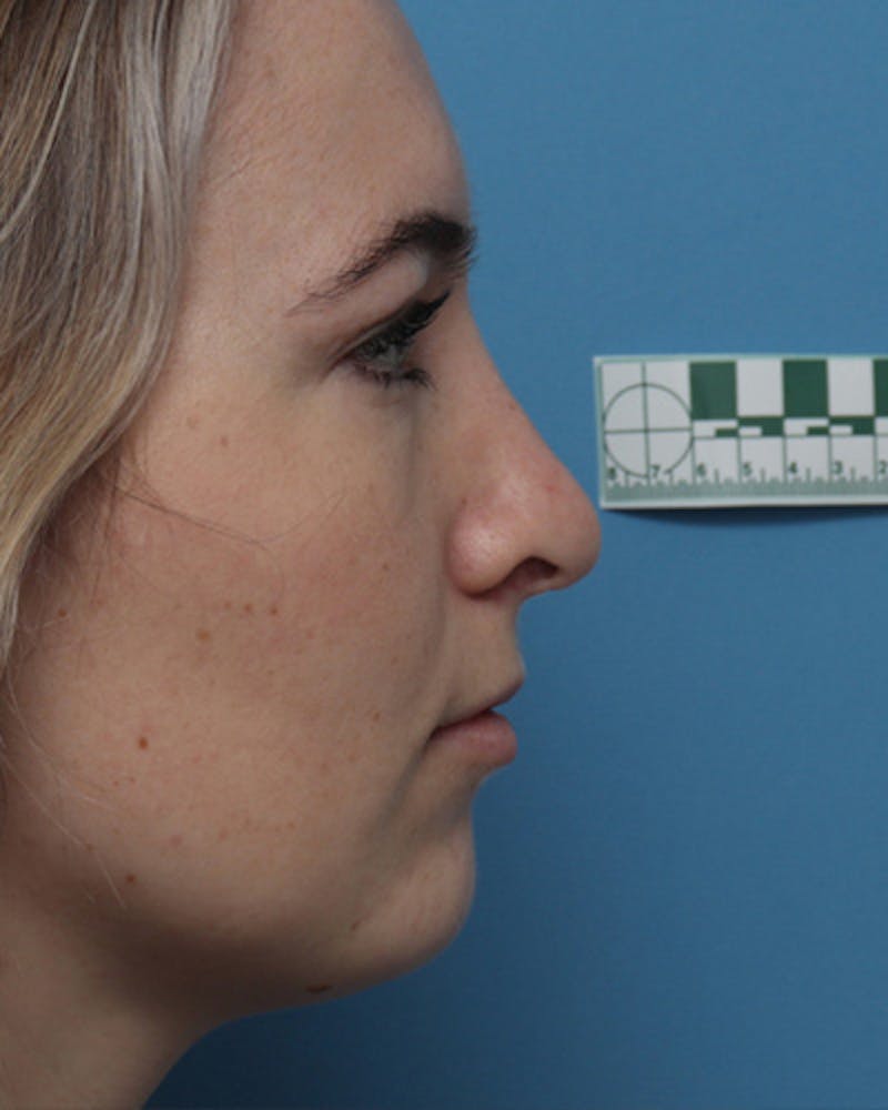 Rhinoplasty Before & After Gallery - Patient 252581 - Image 1