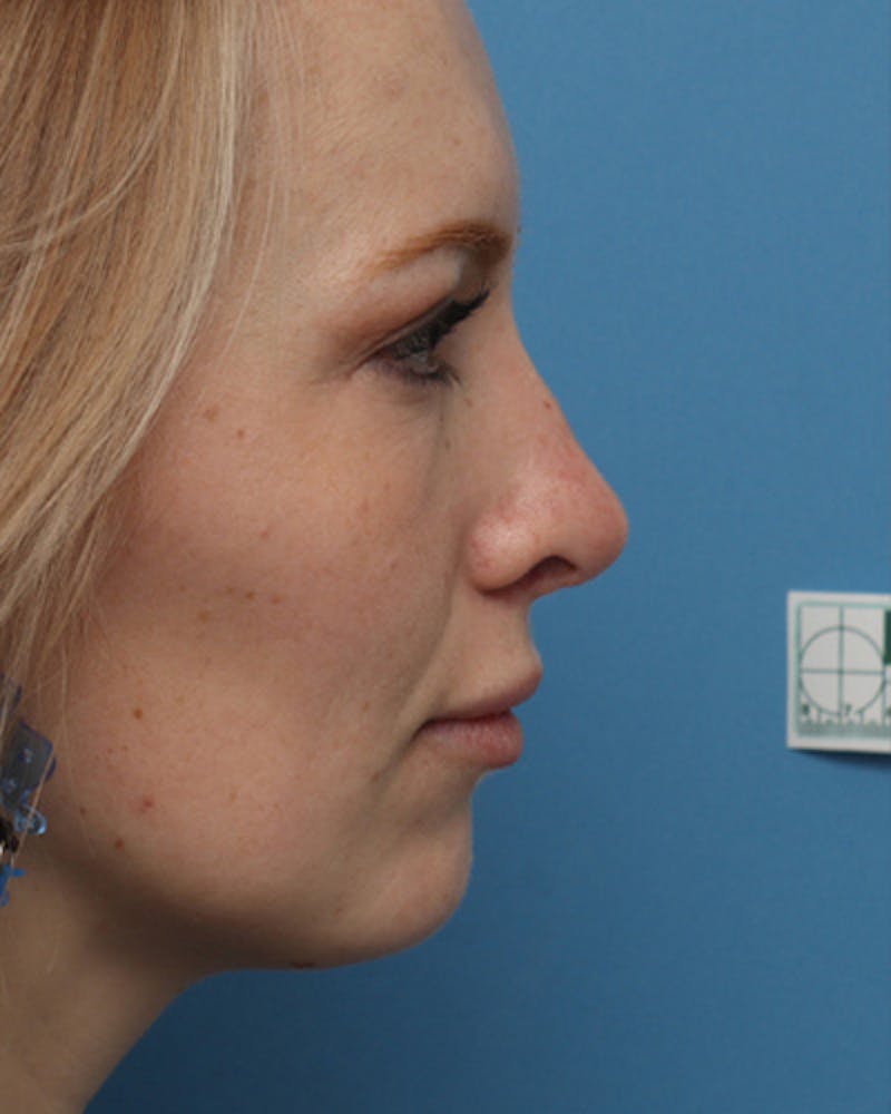 Rhinoplasty Before & After Gallery - Patient 252581 - Image 2