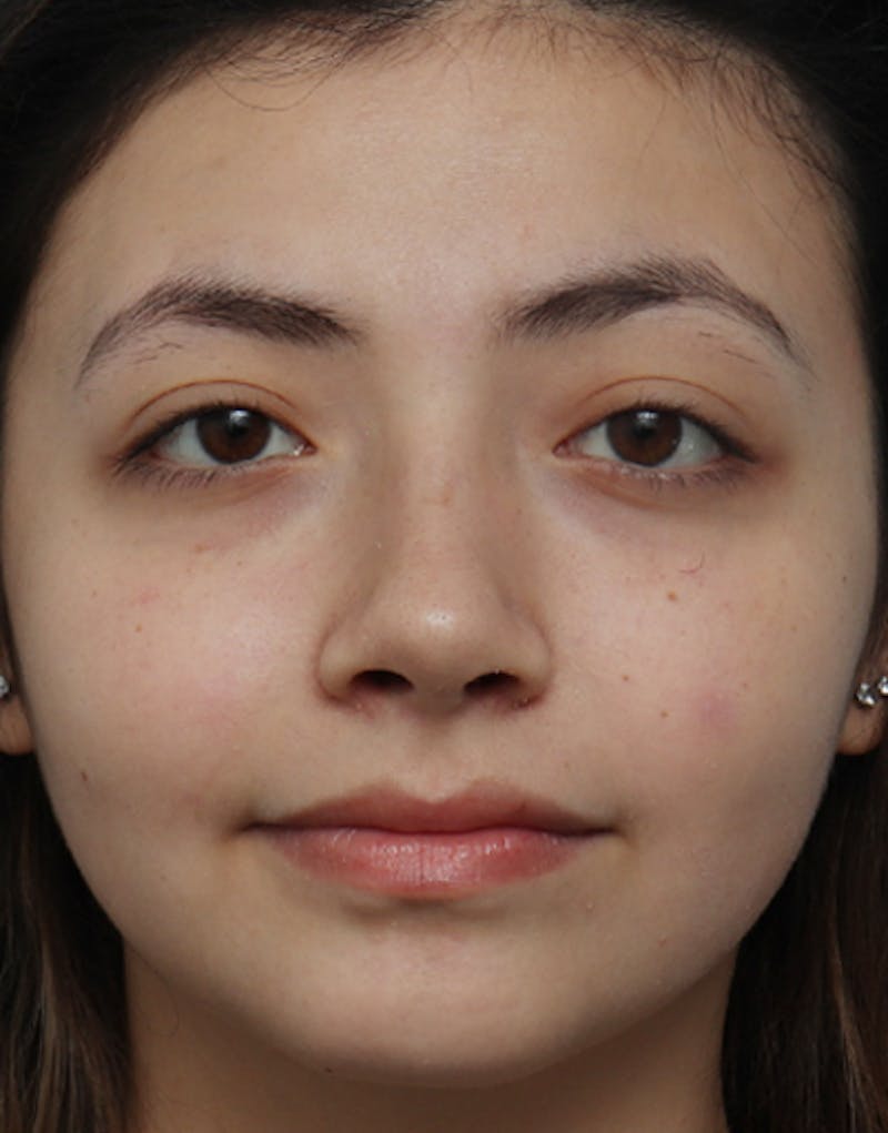 Ethnic Rhinoplasty Before & After Gallery - Patient 233219 - Image 4