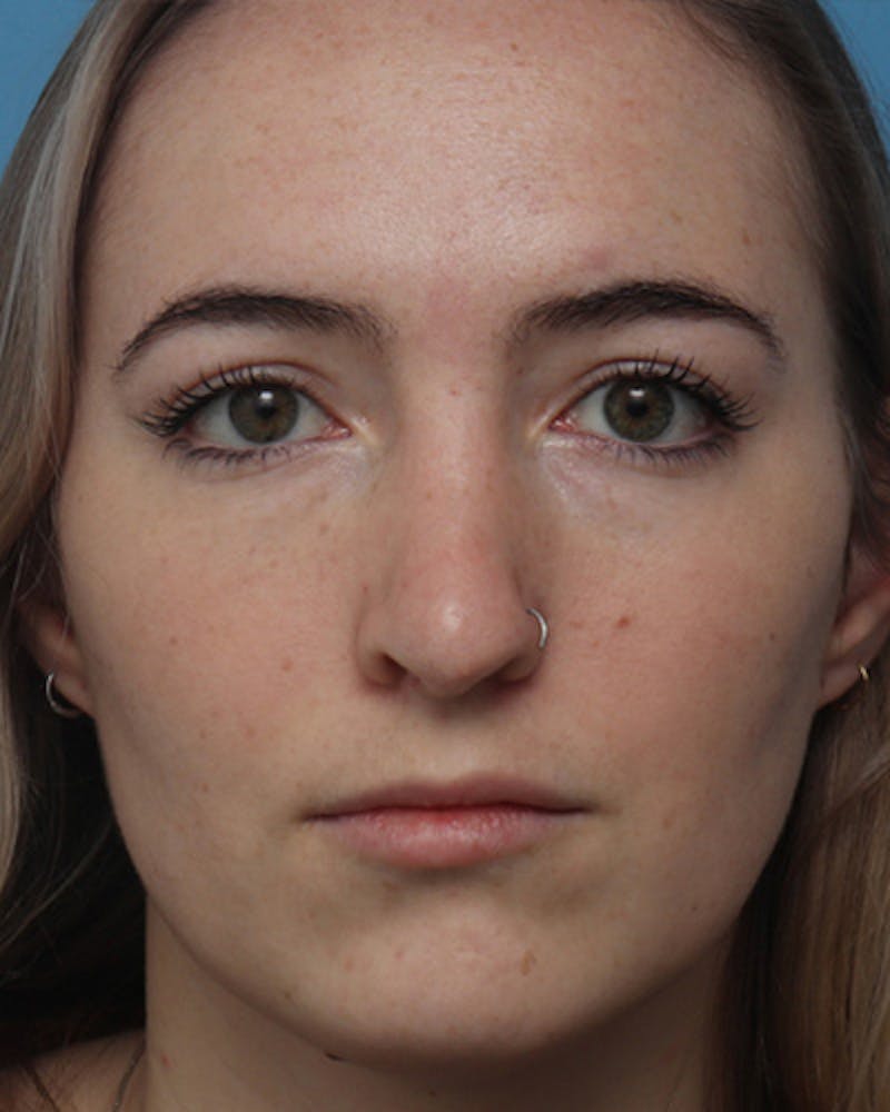 Rhinoplasty Before & After Gallery - Patient 252581 - Image 3