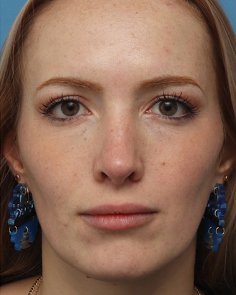 Rhinoplasty Before & After Gallery - Patient 252581 - Image 4