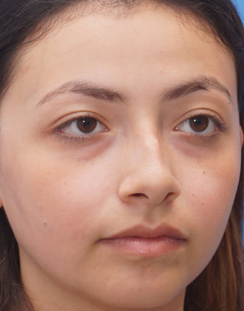 Ethnic Rhinoplasty Before & After Gallery - Patient 233219 - Image 5