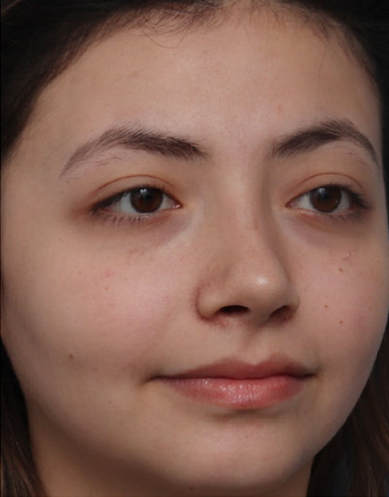 Ethnic Rhinoplasty Before & After Gallery - Patient 233219 - Image 6