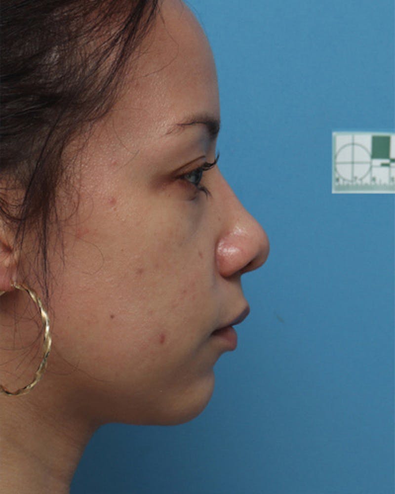 Patient QLNx1WHJRN6O-F_DcNn9ug - Rhinoplasty Before & After Photos