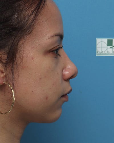 Rhinoplasty Before & After Gallery - Patient 121077 - Image 1
