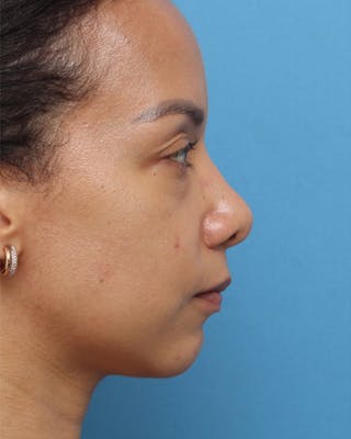 Rhinoplasty Before & After Gallery - Patient 121077 - Image 2