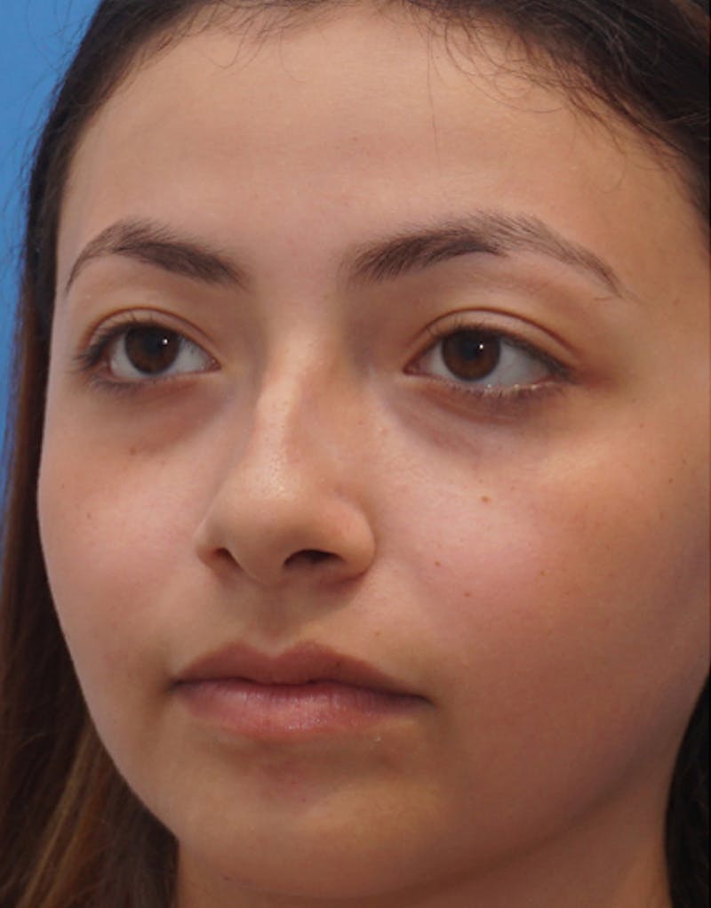 Ethnic Rhinoplasty Before & After Gallery - Patient 233219 - Image 7