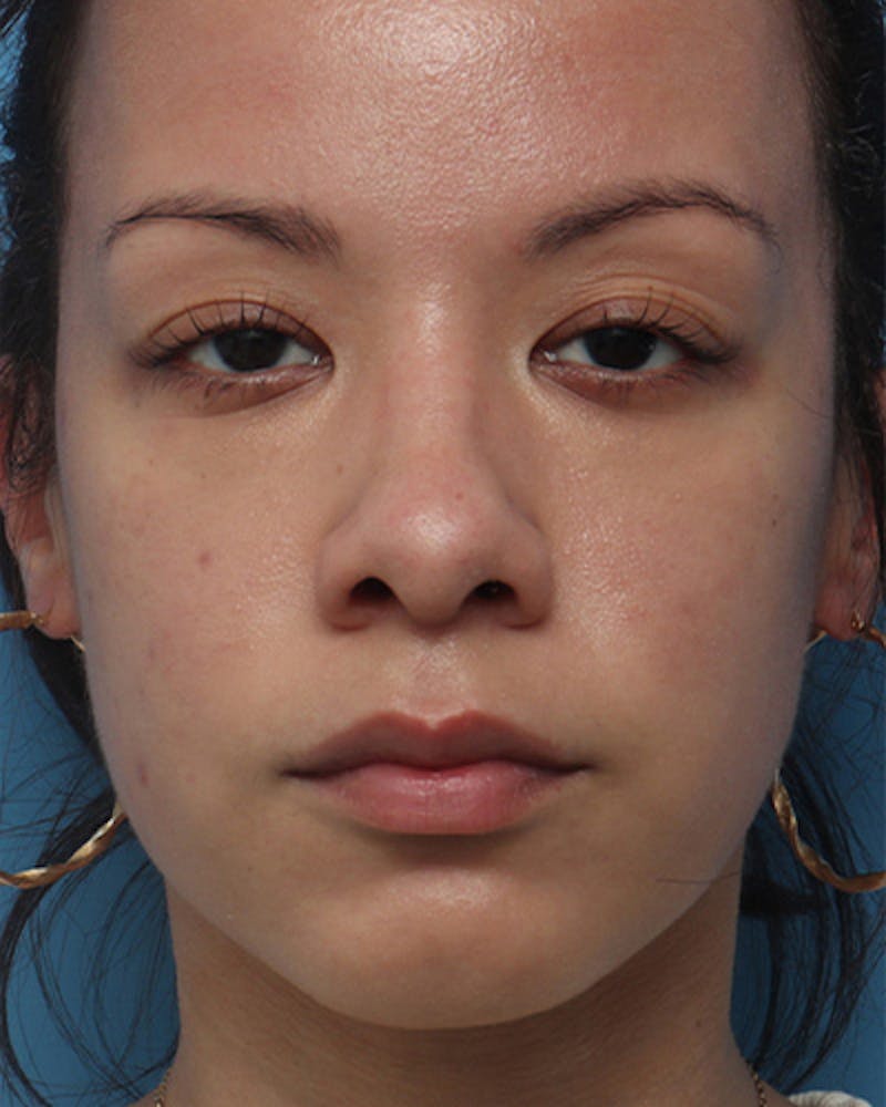 Rhinoplasty Before & After Gallery - Patient 213471 - Image 3