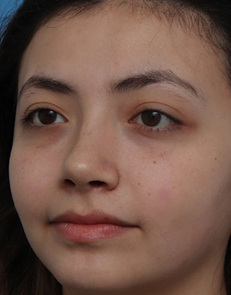 Ethnic Rhinoplasty Before & After Gallery - Patient 233219 - Image 8