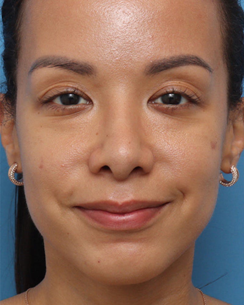 Rhinoplasty Before & After Gallery - Patient 213471 - Image 4