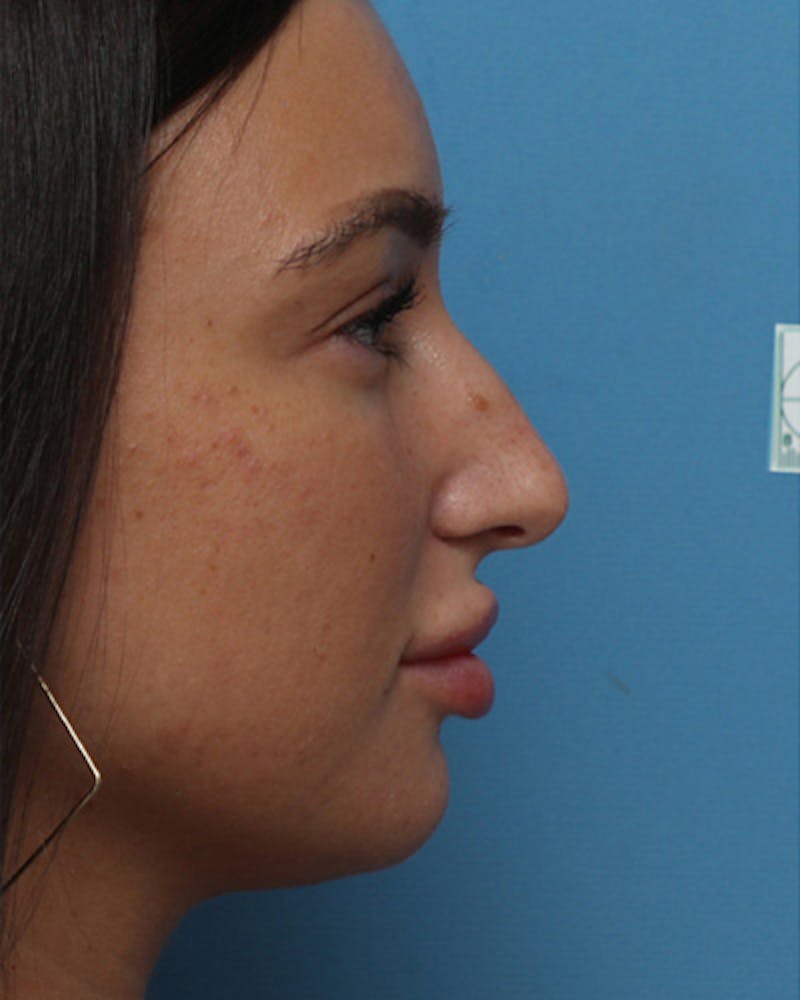 Patient LOZZ_YT7TmuodnH_At5eWw - Rhinoplasty Before & After Photos