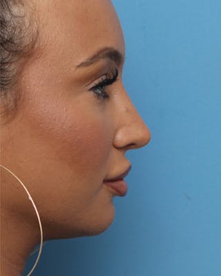 Favorite Rhinoplasty Before & After Gallery - Patient 421263 - Image 2