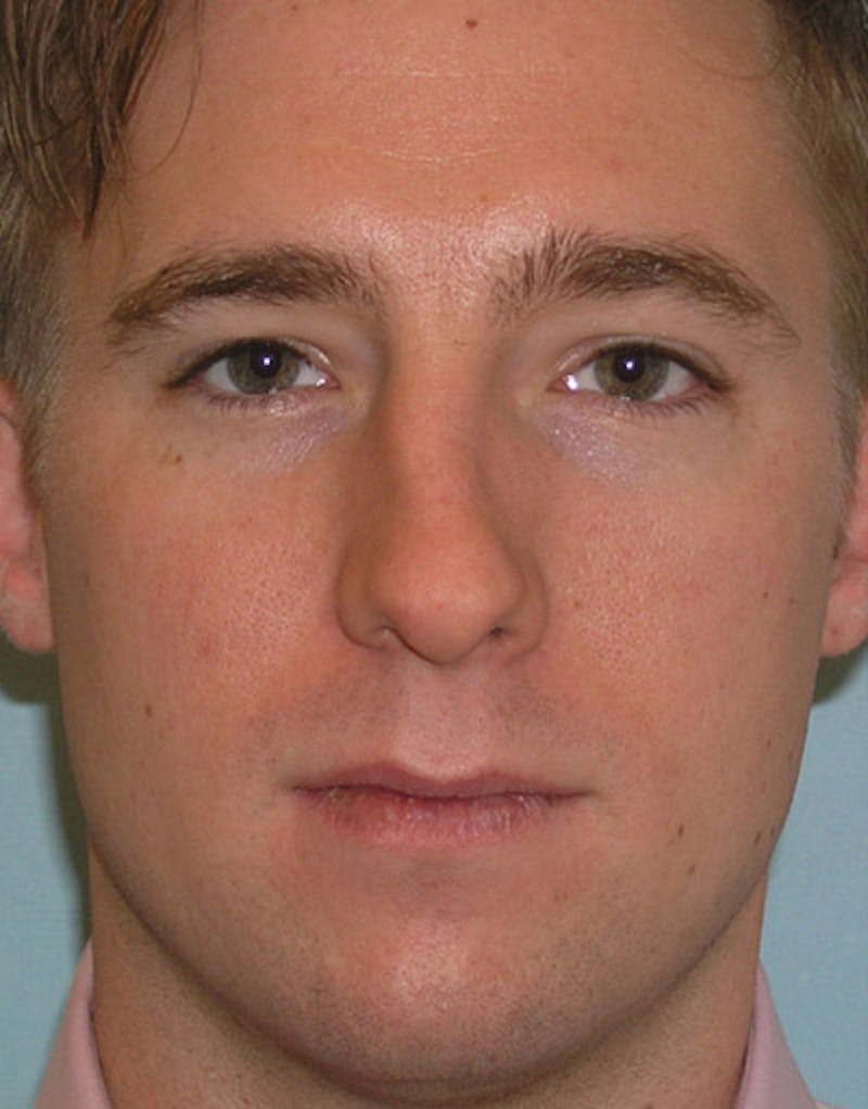 Foundation Rhinoplasty / Crooked Nose Before & After Gallery - Patient 408949 - Image 1