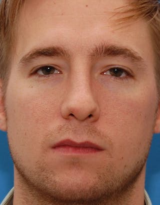 Favorite Foundation Rhinoplasty / Crooked Nose Before & After Gallery - Patient 277500 - Image 2