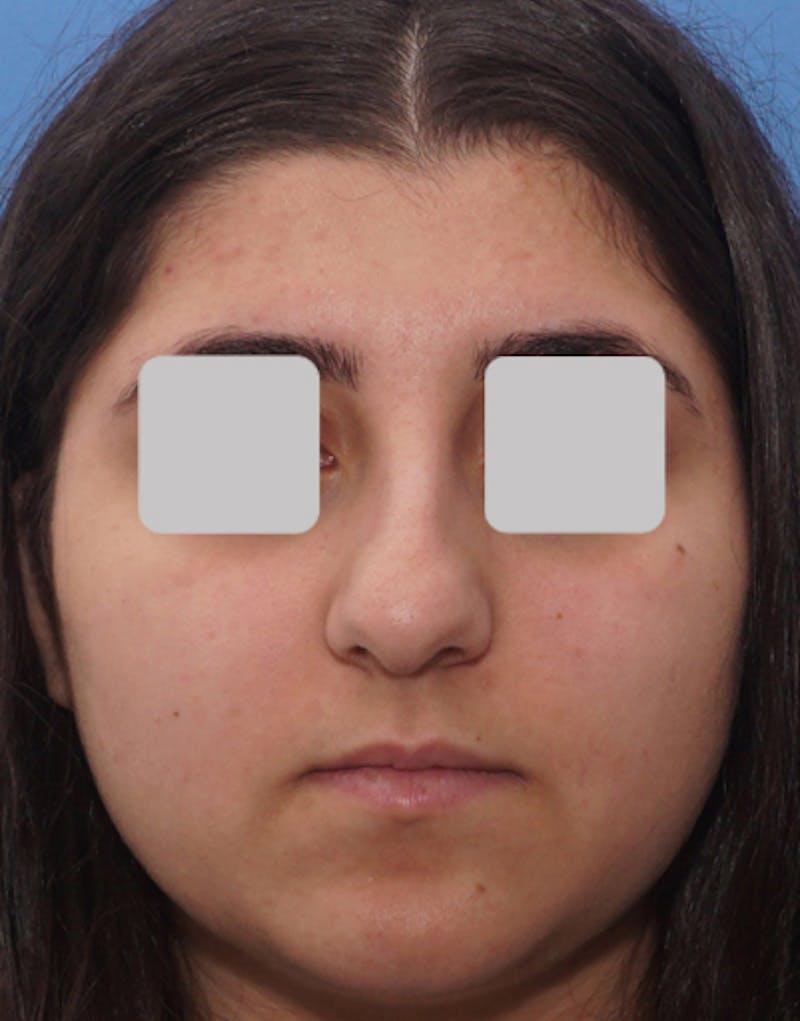 Ethnic Rhinoplasty Before & After Gallery - Patient 228698 - Image 3