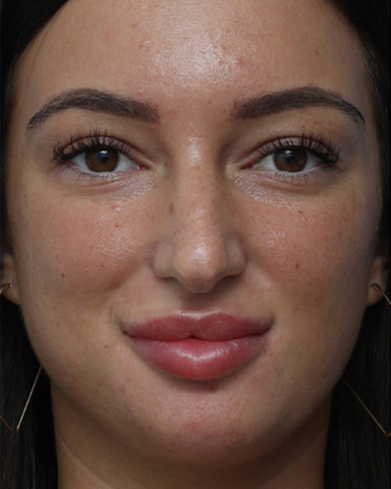 Rhinoplasty  Before & After Gallery - Patient 238093 - Image 3
