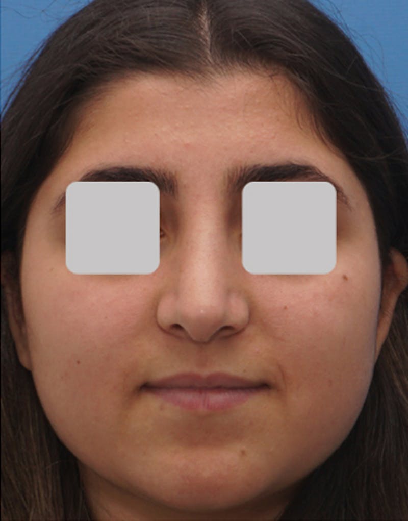 Ethnic Rhinoplasty Before & After Gallery - Patient 228698 - Image 4