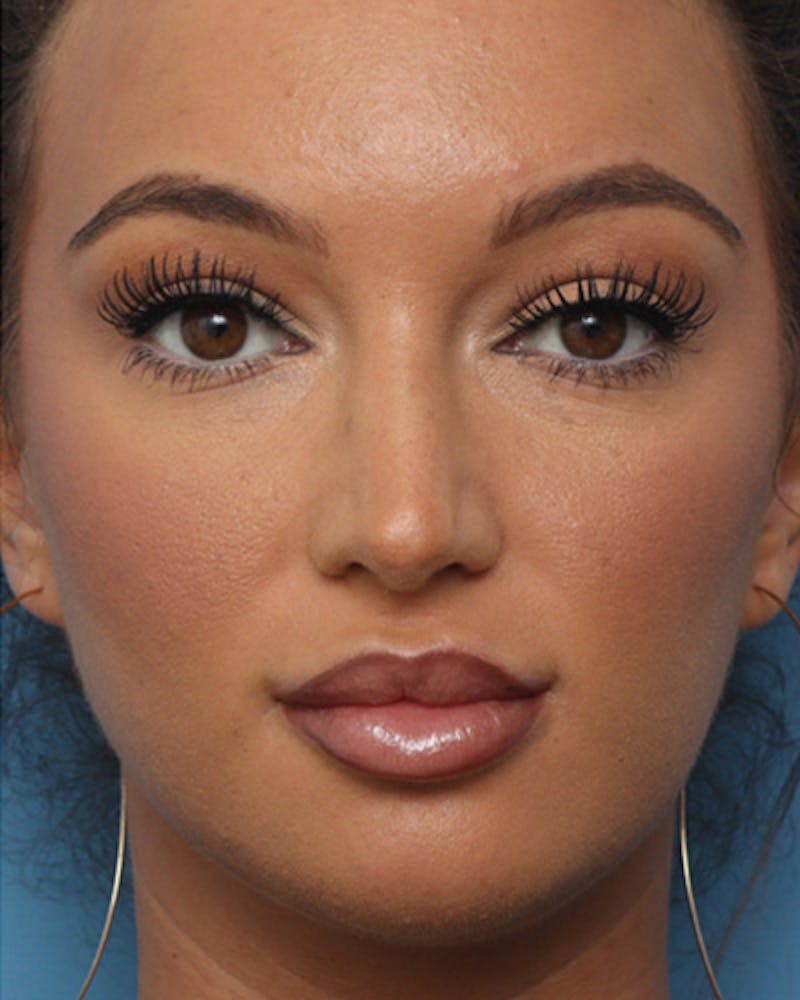 Rhinoplasty  Before & After Gallery - Patient 238093 - Image 4