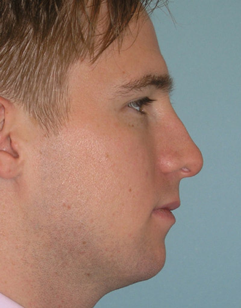 Foundation Rhinoplasty / Crooked Nose Before & After Gallery - Patient 408949 - Image 3