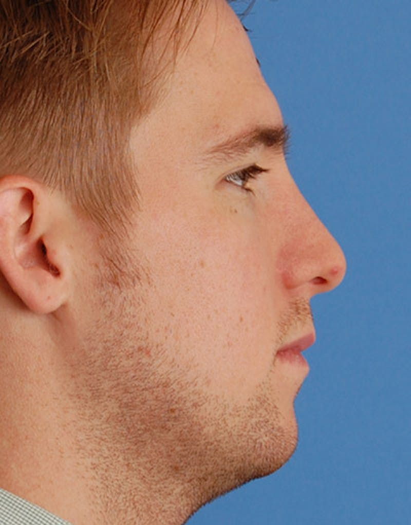 Foundation Rhinoplasty / Crooked Nose Before & After Gallery - Patient 408949 - Image 4
