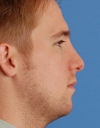 Favorite Foundation Rhinoplasty / Crooked Nose Before & After Gallery - Patient 277500 - Image 4