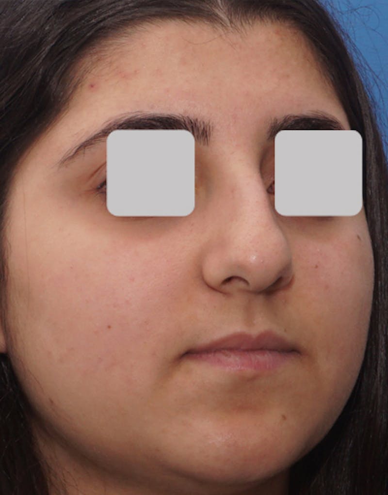 Ethnic Rhinoplasty Before & After Gallery - Patient 228698 - Image 5