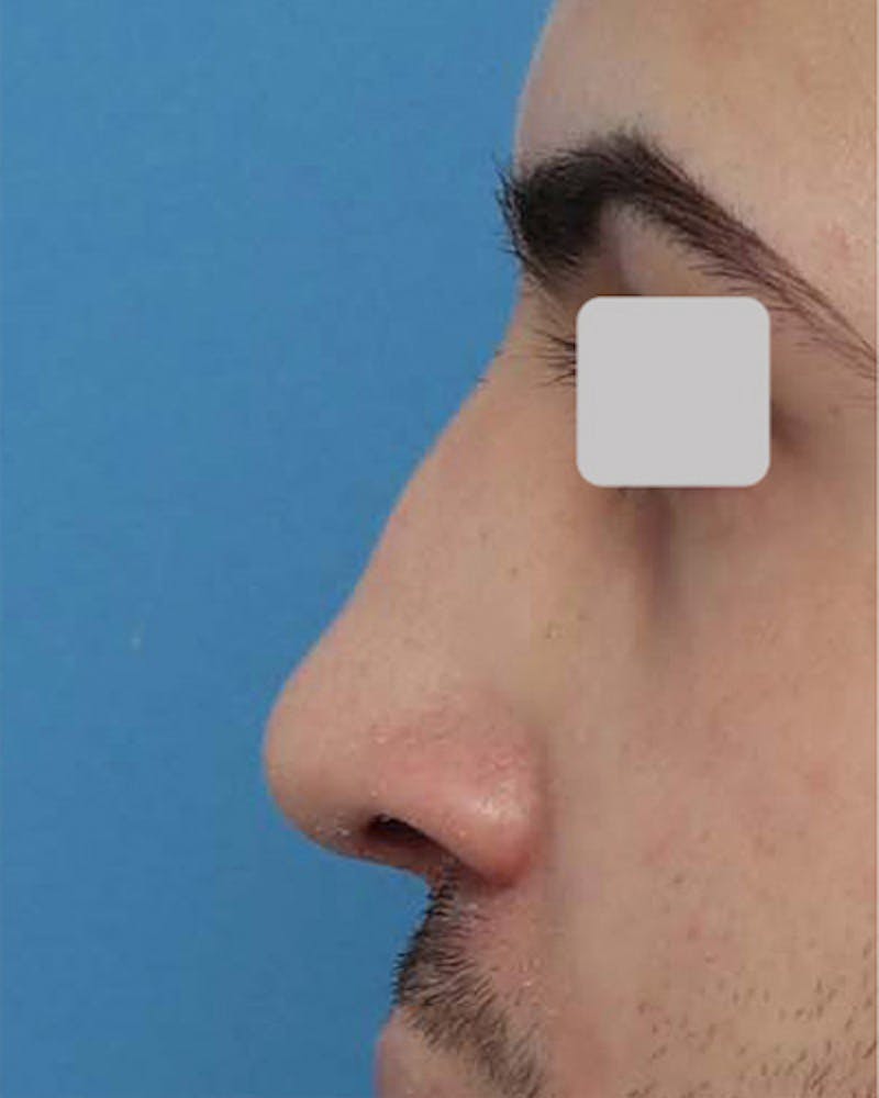 Patient J8K2_Ig2Q6SFPPJYSagKTA - Male Rhinoplasty Before & After Photos