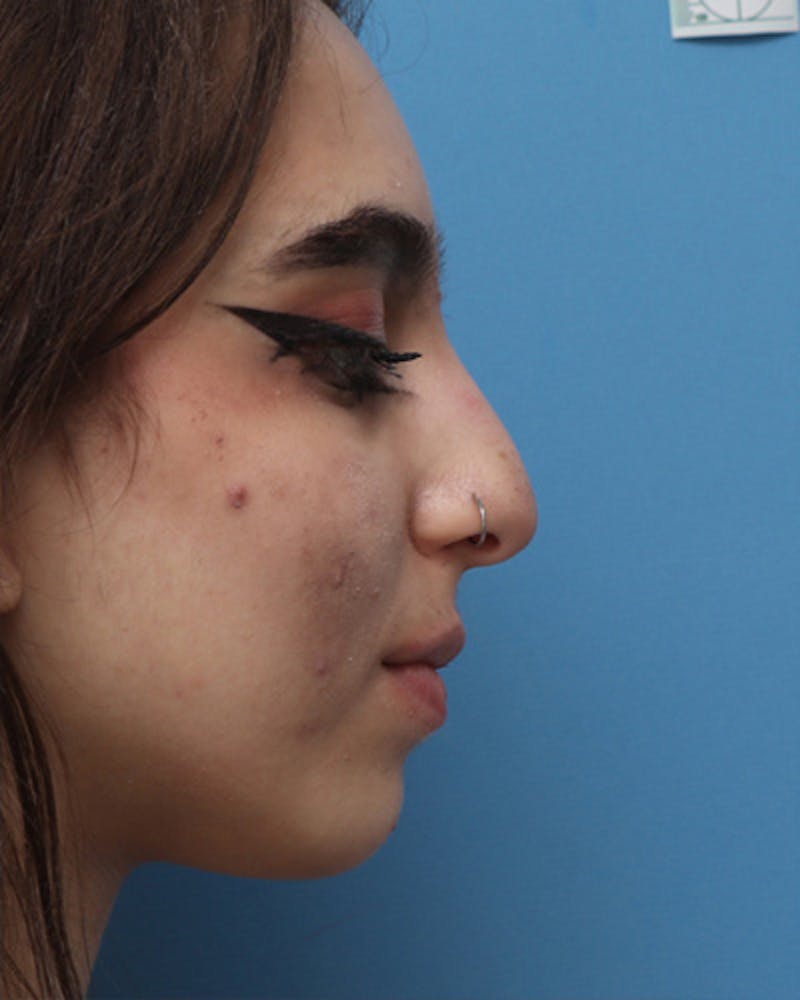 Patient CRAmYSWjRMKWlBZrA_cc4w - Rhinoplasty Before & After Photos