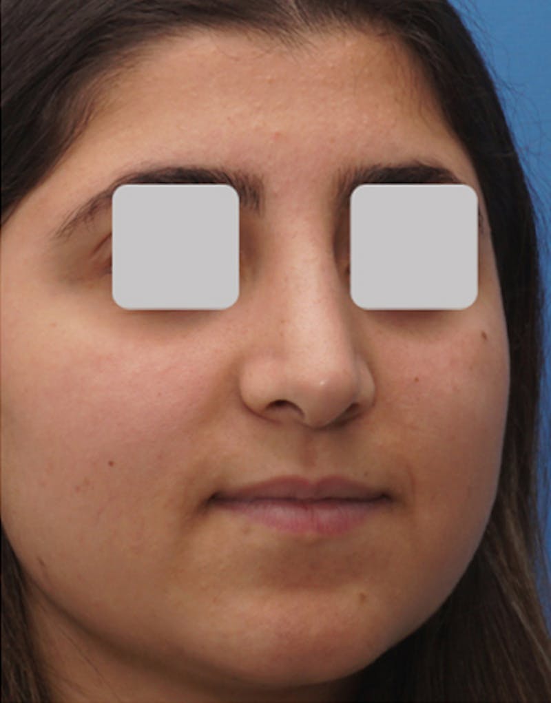 Ethnic Rhinoplasty Before & After Gallery - Patient 228698 - Image 6