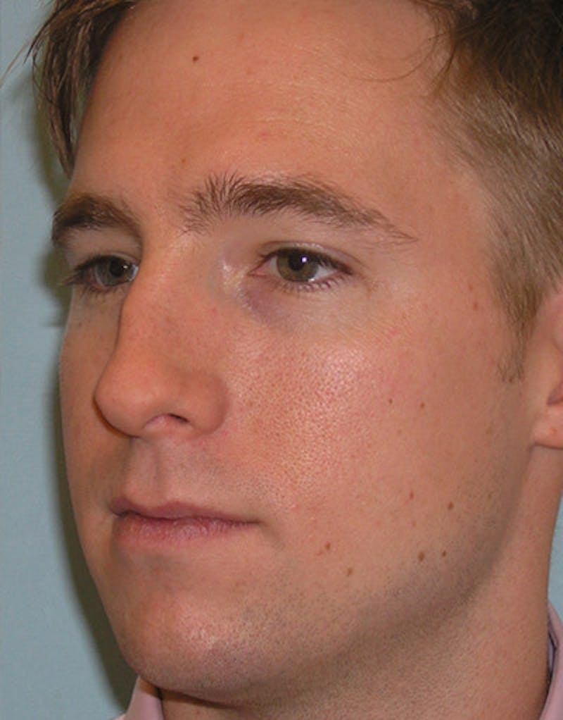 Rhinoplasty  Before & After Gallery - Patient 167615 - Image 5