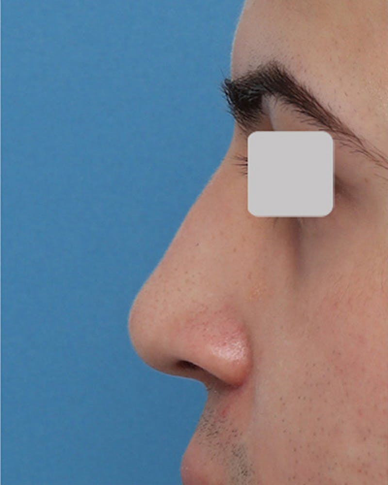 Rhinoplasty Before & After Gallery - Patient 851880 - Image 2