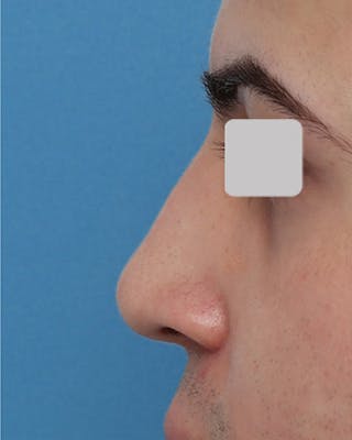Non-Surgical Rhinoplasty Before & After Gallery - Patient 271700 - Image 2