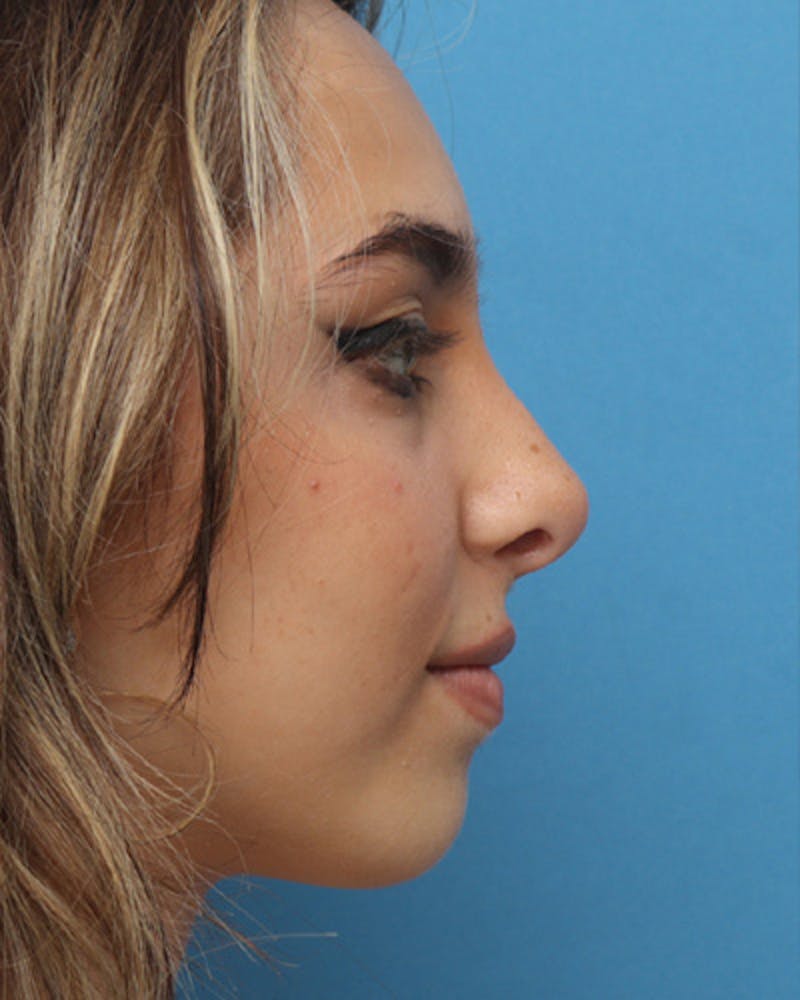 Rhinoplasty Before & After Gallery - Patient 248759 - Image 2