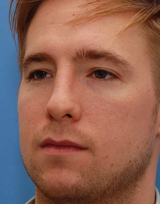 Favorite Foundation Rhinoplasty / Crooked Nose Before & After Gallery - Patient 277500 - Image 6