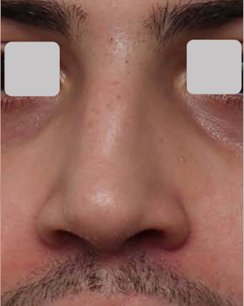 Rhinoplasty Before & After Gallery - Patient 851880 - Image 3