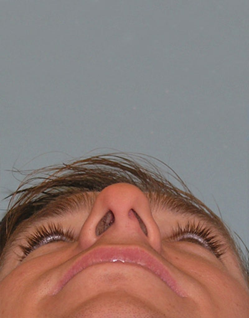 Rhinoplasty  Before & After Gallery - Patient 167615 - Image 7